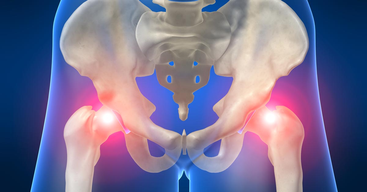 Sciatica & Sciatic Nerve Pain Chiropractor St. Louis, MO