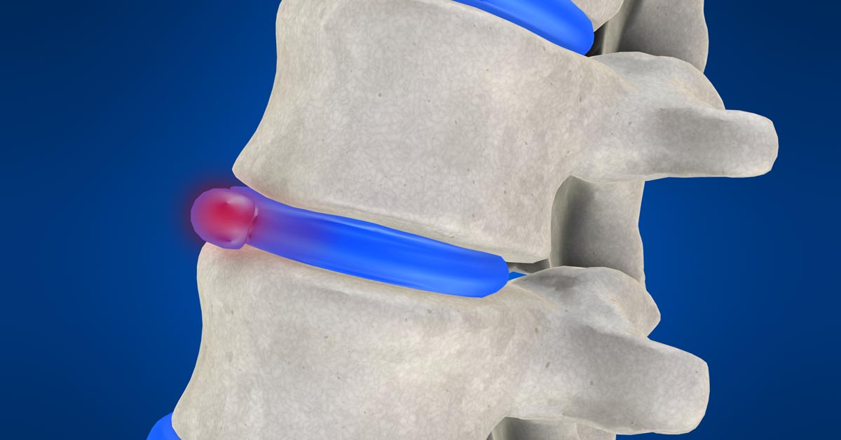 Spinal decompression therapy in Downtown St. Louis, MO