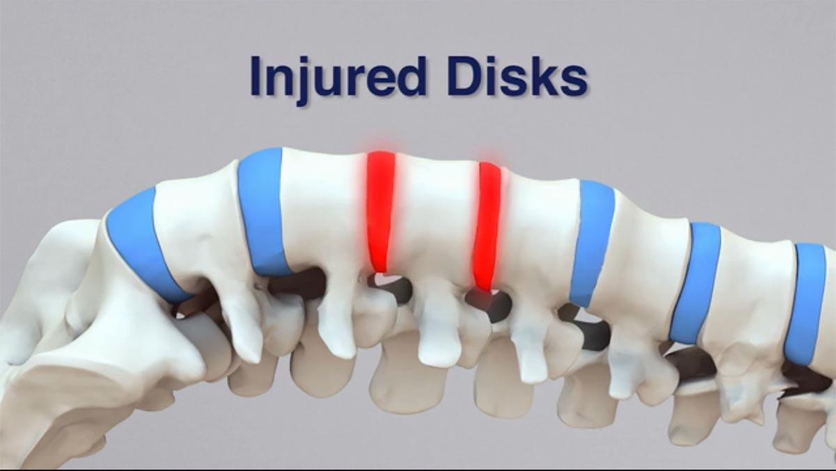 North St. Louis, MO non-surgical spinal decompression